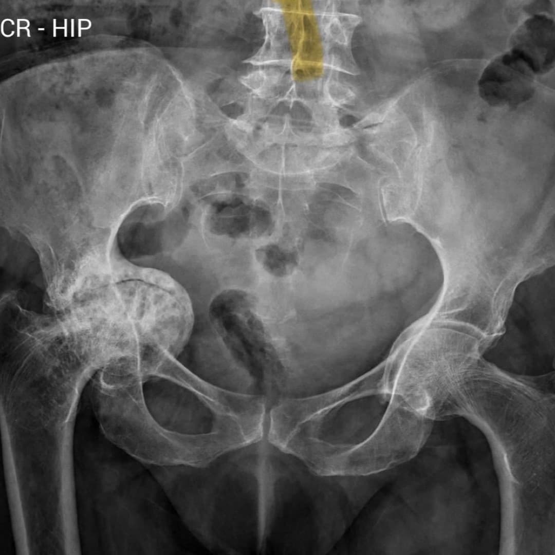 Dr Mujahid Jamil Khattak hip and knee surgery — practice highlight 1