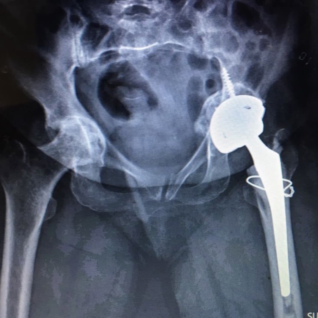 Dr Mujahid Jamil Khattak hip and knee surgery — practice highlight 2