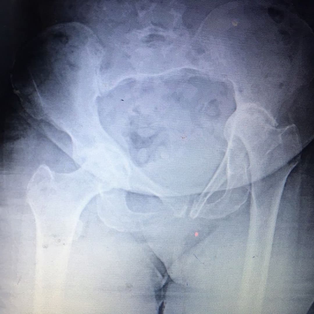 Dr Mujahid Jamil Khattak hip and knee surgery — practice highlight 2