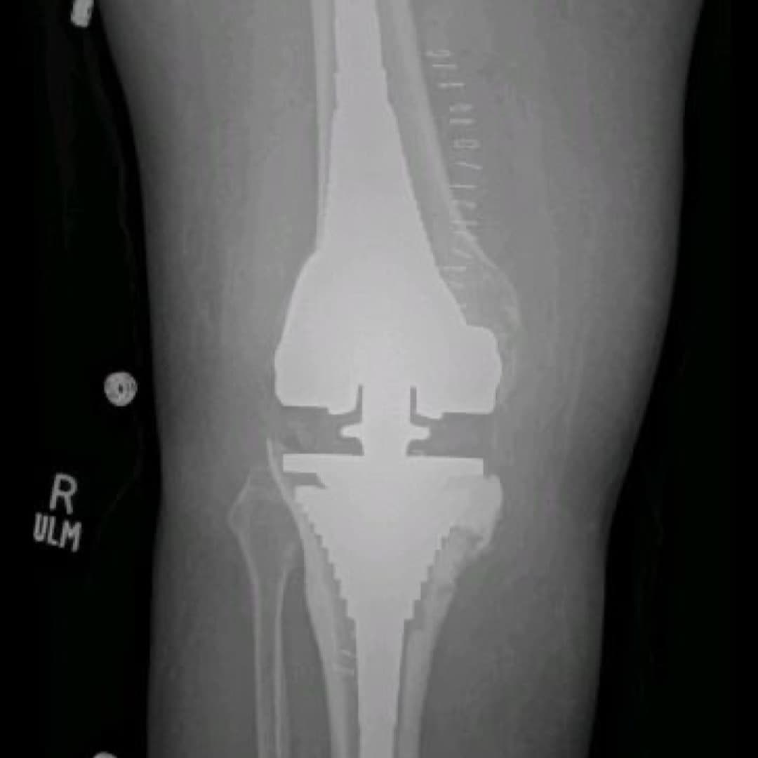 Dr Mujahid Jamil Khattak hip and knee surgery — practice highlight 3