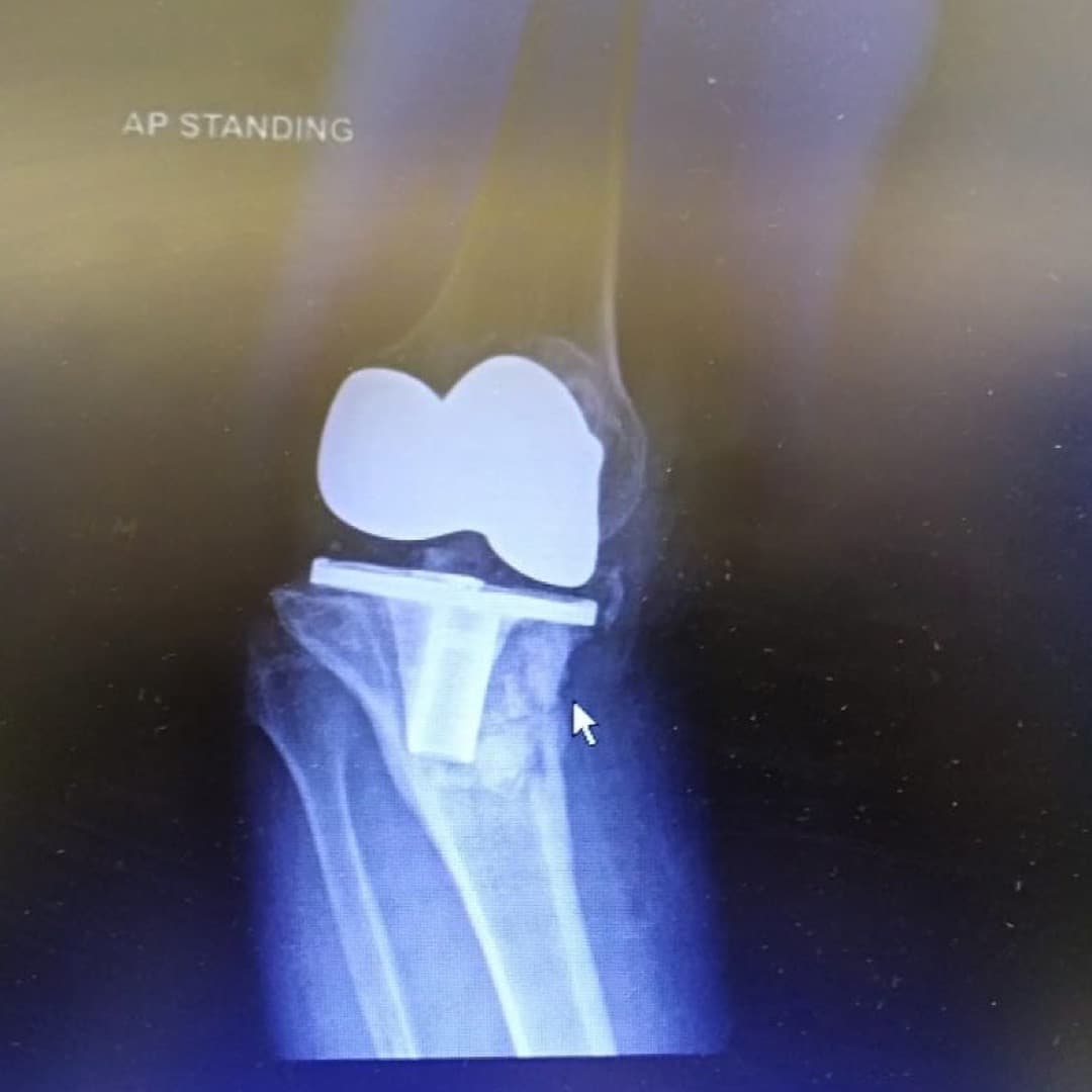 Dr Mujahid Jamil Khattak hip and knee surgery — practice highlight 3