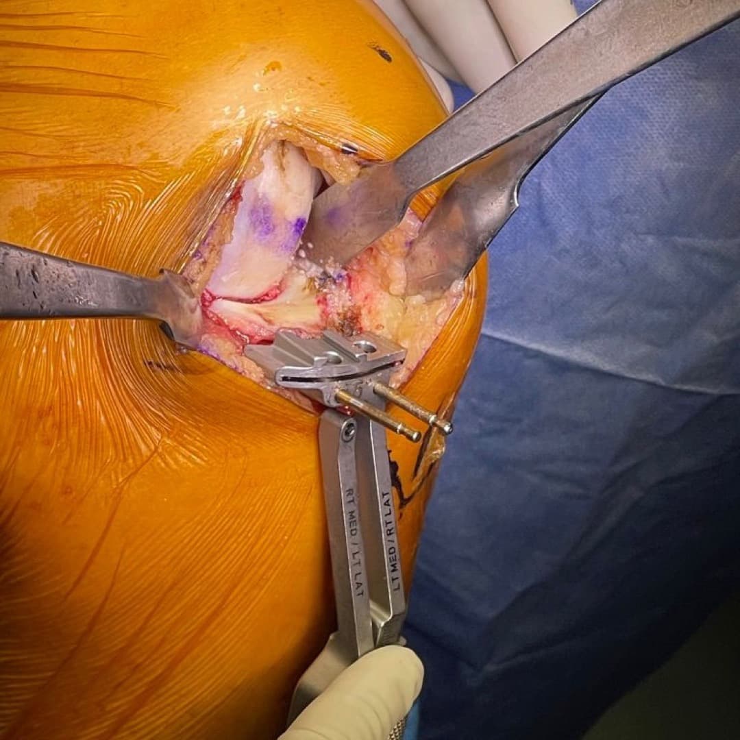 Dr Mujahid Jamil Khattak hip and knee surgery — practice highlight 4