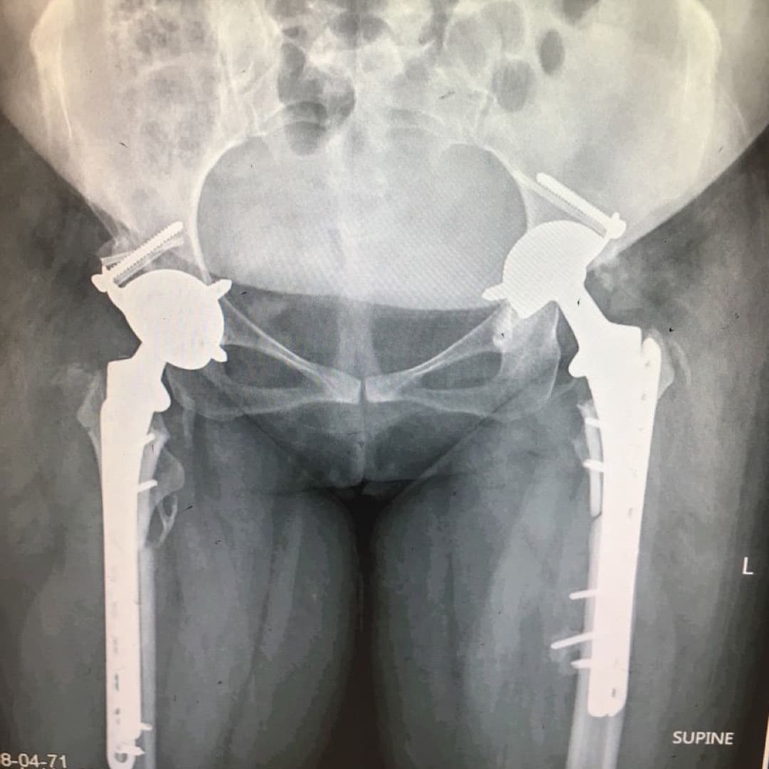 Dr Mujahid Jamil Khattak hip and knee surgery — practice highlight 5