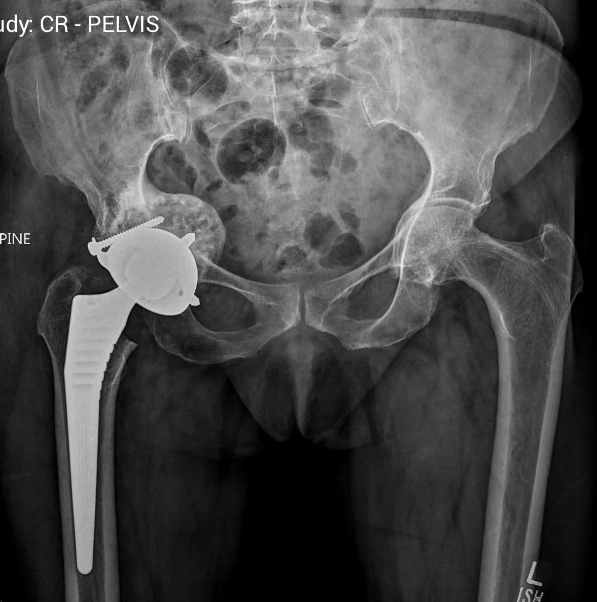 Dr Mujahid Jamil Khattak hip and knee surgery — practice highlight 1b