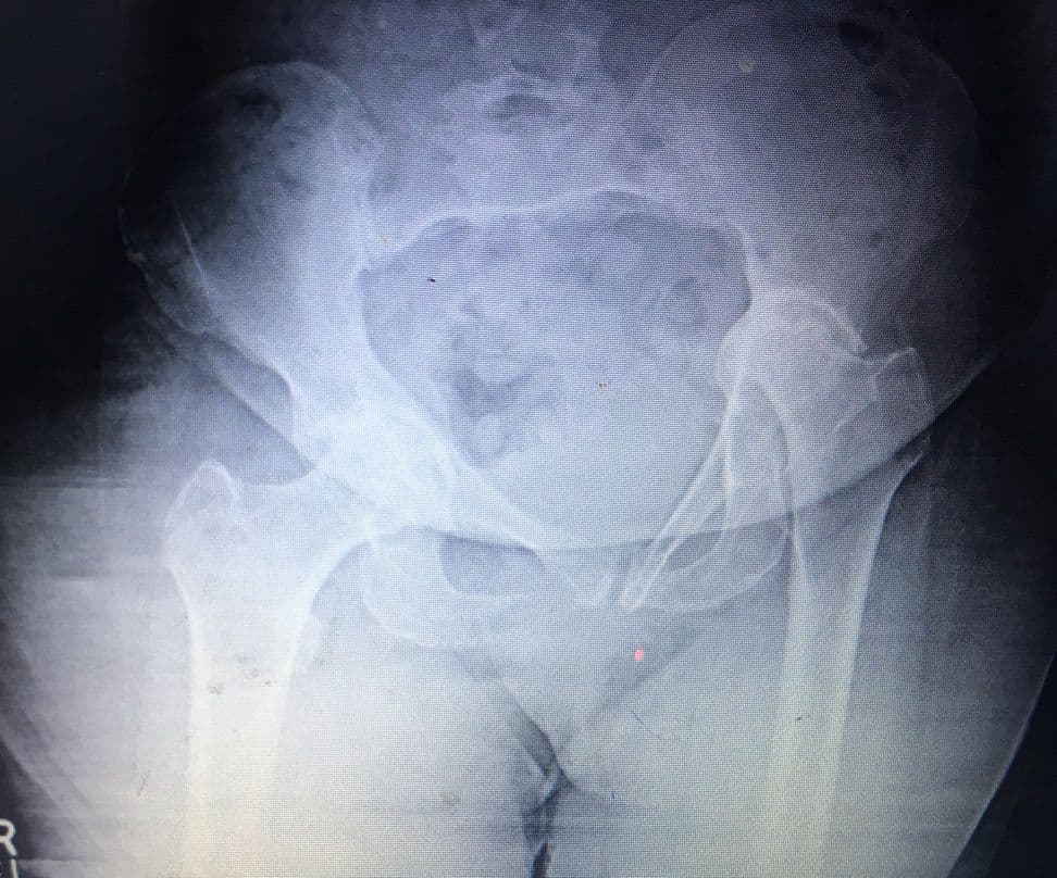 Dr Mujahid Jamil Khattak hip and knee surgery — practice highlight 2b