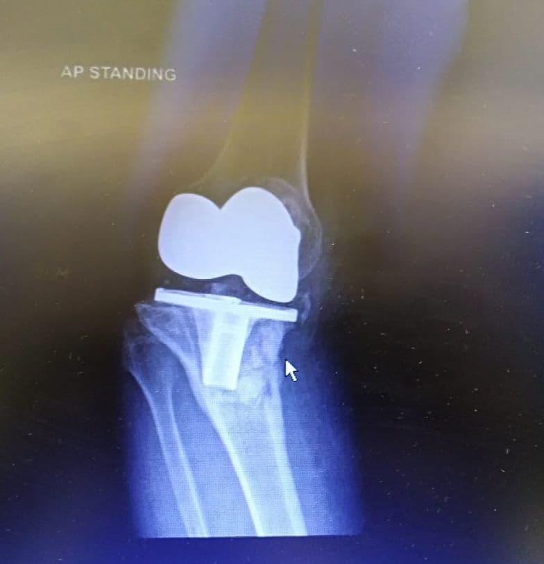 Dr Mujahid Jamil Khattak hip and knee surgery — practice highlight 3b