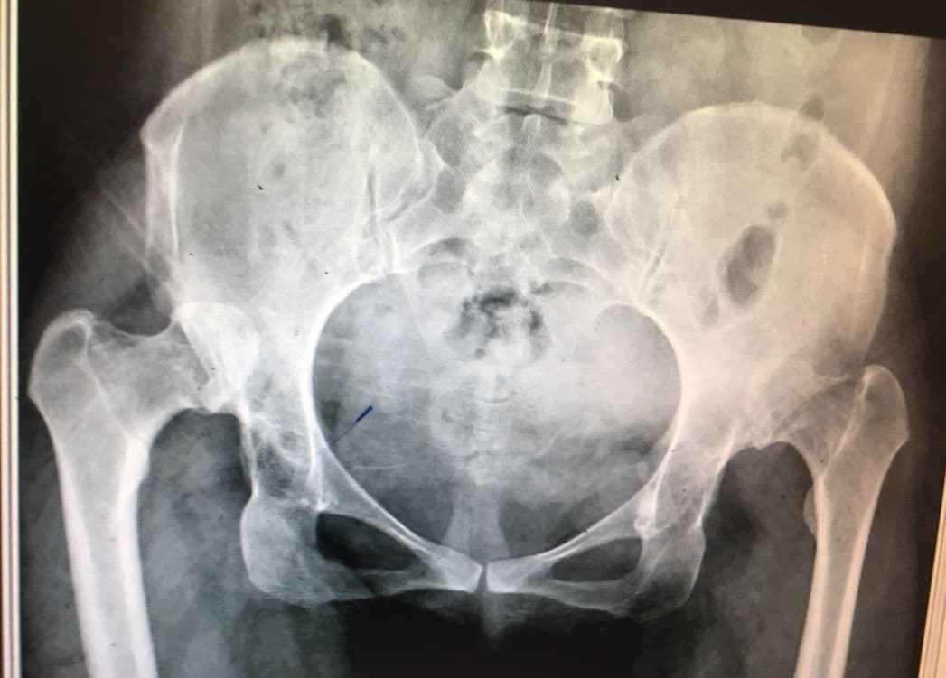 Dr Mujahid Jamil Khattak hip and knee surgery — practice highlight 5a